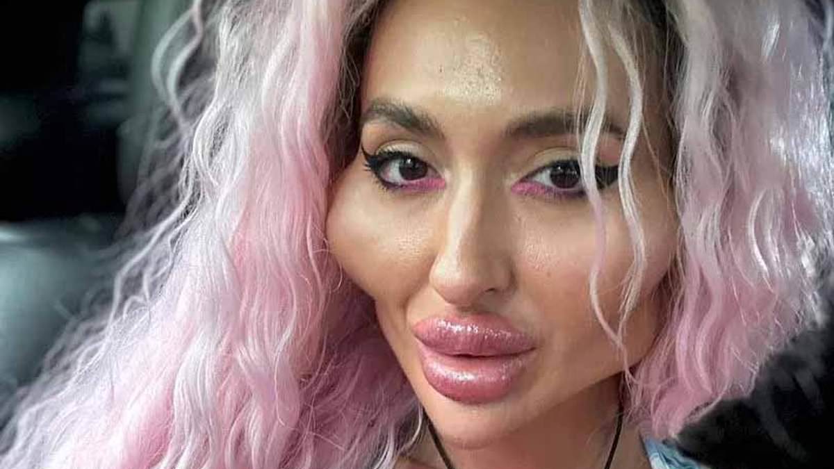 Ukrainian influencer with ‘world’s biggest cheeks’ reveals what she looked like before she spent 1,600 on filler [Video]