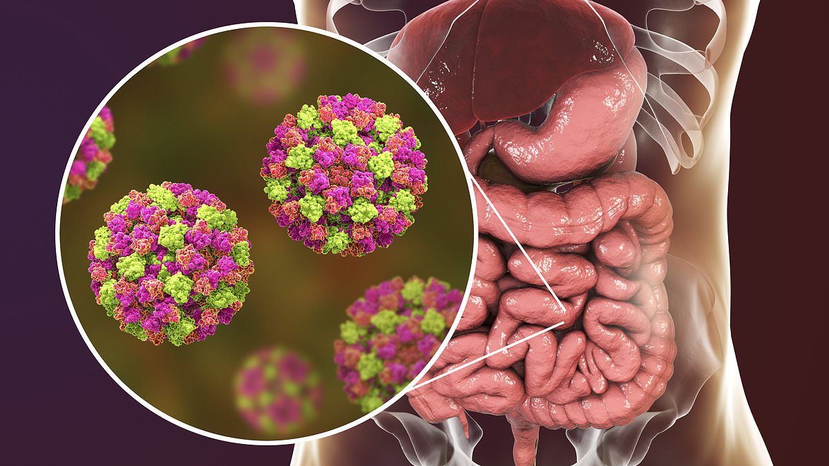 Warning of ‘winter vomiting bug’ outbreak… in May! Norovirus infections hit a five-year seasonal high as health chiefs urge public to stay off work for two days if suffering symptoms [Video]